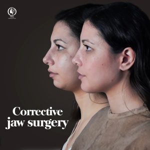 Before and after jaw surgery result – Case 1 at Pera Clinic, Turkey