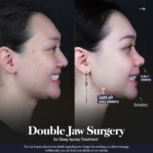 Corrective jaw surgery result – Case 8 before and after, Istanbul
