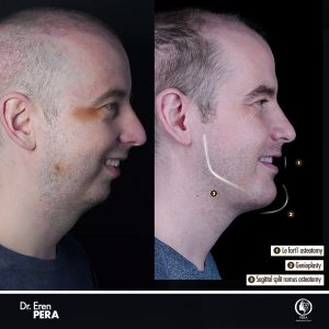 Facial asymmetry correction result – Case 5, Pera Clinic, Istanbul