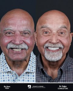 Before and after zygomatic implants showing full smile restoration at Pera Clinic in Turkey