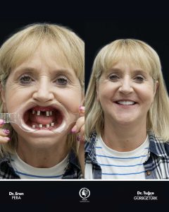 zygomatic-implants-before-after-2