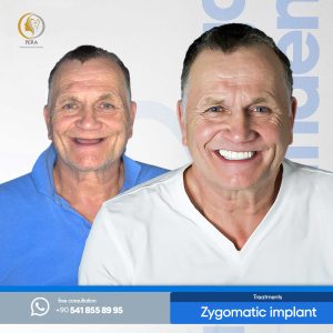 zygomatic-implants-before-after-3