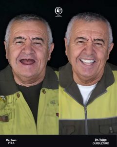 Zygomatic implant treatment results in facial symmetry and improved bite function – Pera Clinic Istanbul