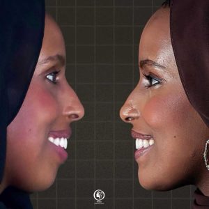 Side profile view before and after orthognathic surgery correcting jaw alignment