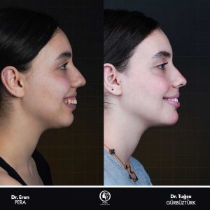 Before and after results of orthognathic and chin surgery for facial harmony