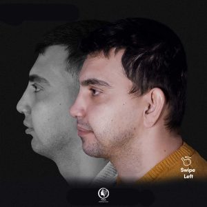 Transformation of jawline and chin appearance after orthognathic surgery