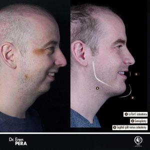Lower face reshaping before and after jaw and chin surgery