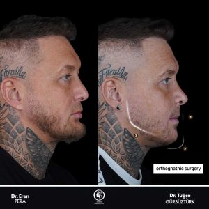 Correction of facial asymmetry with orthognathic surgery — before and after comparison