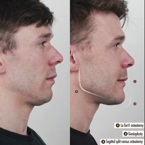 dathan-horridge-double-jaw-before-after