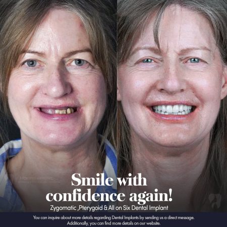 all-on-6-zygomatic-implants-before-after Before and after photo showing full mouth restoration with All-on-6, zygomatic, and pterygoid dental implants at Pera Clinic