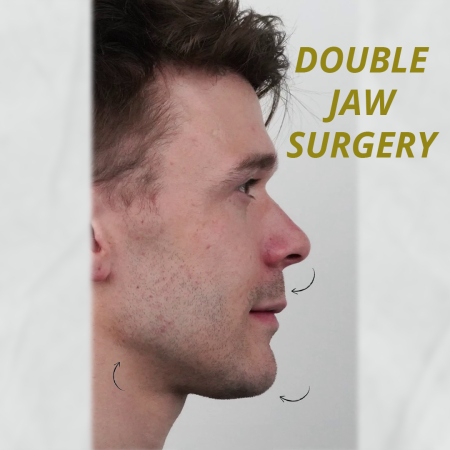 Side profile of Dathan Horridge, a UK patient after undergoing double jaw surgery and genioplasty with Dr. Eren Pera at Hospitaprime in Turkey. The image highlights the symmetry and aesthetic improvement post-surgery