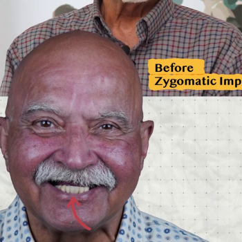 Dr. Farid Qazi before and after zygomatic implants at Pera Clinic – full smile restoration for severe upper jaw bone loss