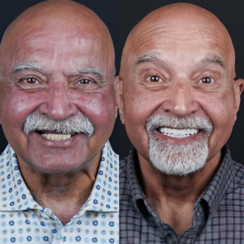 Before and after zygomatic implants showing full smile restoration at Pera Clinic in Turkey